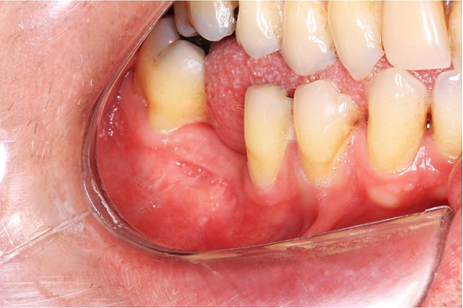 Intraoral examination after the treatment showing complete remission of the initial lesion.