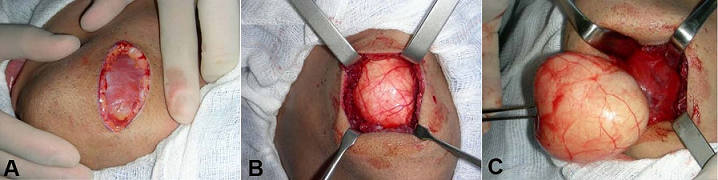 A – Extraoral incision performed for surgical removal of the lesion;
B and
C – Intraoperative panoramic view of the tumor.