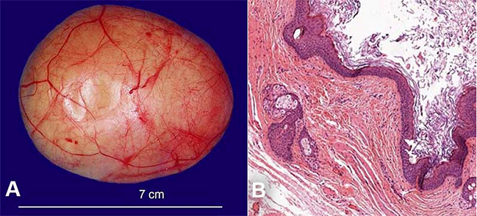 A – Gross aspect showing a well-circumscribed, solid oval mass, with a yellowish surface;
B – Photomicrograph of the cyst wall showing an orthokeratinized stratified squamous epithelium supported by a fibrous wall of dense connective tissue with the presence of variable numbers of sebaceous glands. Keratinous debris could also be seen in the lumen (Hematoxylin & eosin, original magnification 100x).