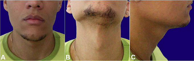 A and
B – Frontal and
C – lateral view of the patient two years after the surgical removal of the lesion, without signs of relapse.