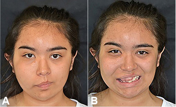 Gross examination of the patient before the surgical treatment 
							(A), and 2 years after the surgical treatment 
							(B).