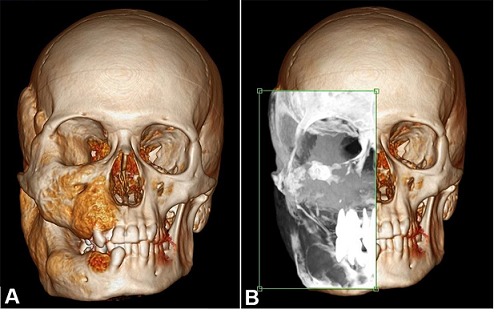 A &ndash; 3D reformation of the facial and cranium computed tomography of patient number 1. 
							B &ndash; Analysis of the ground glass appearance in the involved area.
						