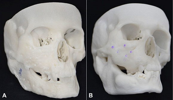 A &ndash; Lateral view of the stereolithography model, before surgery; 
							B &ndash; Lateral view of the stereolithography model, after surgery.
						