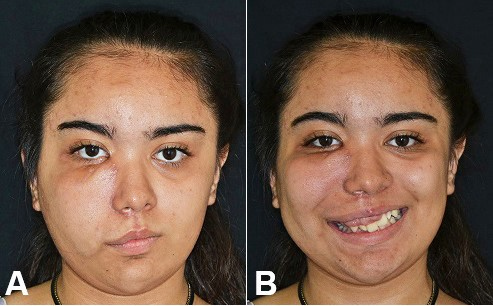 A and 
							B &ndash; Gross examination of the patient 2 years after the surgical treatment.
						