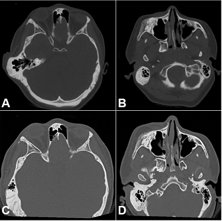Facial CT. 
							A &ndash; Axial plane showing the temporal region before the surgical treatment, 
							B &ndash; Axial plane showing the zygomatic-maxillary region before the surgical treatment, 
							C &ndash;Axial plane showing the temporal region 2 years after the surgical treatment, 
							D &ndash; CT plane showing the zygomatic-maxillary region after the surgical treatment.
						
