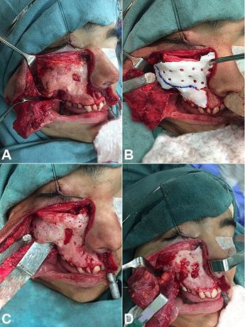 Intraoperative images of the case #2. 
							A &ndash; Exhibition of the area of interest; 
							B &ndash; Guide placement; 
							C &ndash; After realization of the perforations in their respective depths; 
							D &ndash; After wear and bone resection.
						