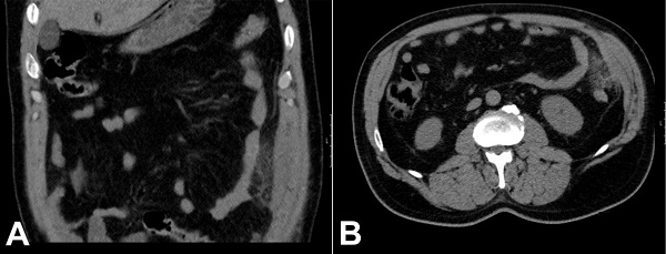 Abdominopelvic CT scan, coronal view (A) and axial view (B), of left omental infarction.
