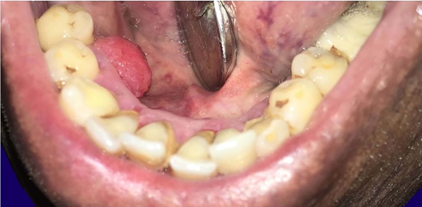 Clinical examination: showing an exophytic growth in the lingual aspect of the right mandibular premolars area.