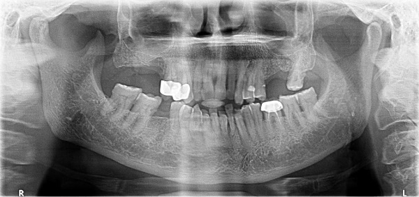 Radiographic examination: without bone involvement.