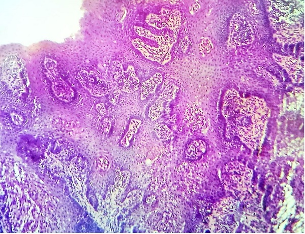 Photomicrograph of the incisional biopsy specimen showing pseudo epitheliomatous hyperplasia.