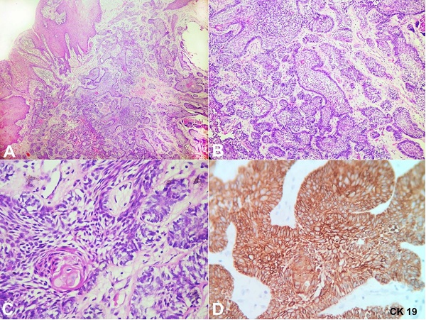Photomicrographs of the surgical specimen showing in A - islands of odontogenic epithelium present close to the surface epithelium (H&E, 4X); B - Odontogenic epithelial islands with palisading peripheral cells (H&E, 10X); C - Central squamous metaplasia of odontogenic epithelium (H&E, 40X); D - CK 19 positivity.