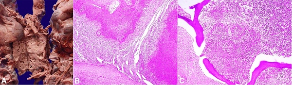 A - Gross view of enlarged, matted para-aortic lymph nodes with cavitating lesions filled with necrotic material; B - Photomicrograph of the lymph node showing large areas of necrosis surrounded by histiocytes (H&E, 40X); C - Photomicrograph showing similar suppurative granulomas in the bone marrow (H&E, 100X).
