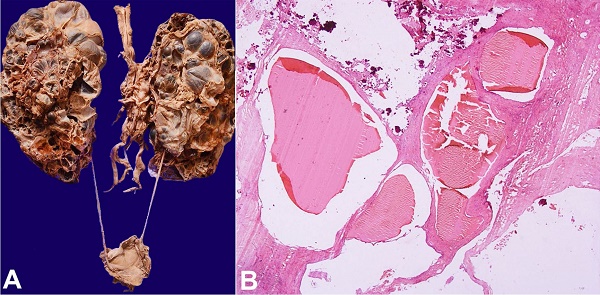 A - Macroscopic view of the urinary system showing massively enlarged and heavy kidneys studded with multiple variable-sized cysts filled with clear to tan color fluid and granular material; B - Photomicrograph of the kidney showing flattened to cuboidal lining epithelium containing eosinophilic material (H&E, 40X).