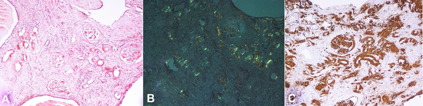 Photomicrographs of the kidney showing in A - Residual renal parenchyma noted in septa with interstitial fibrosis and hyalinization along with atrophic tubules and scattered glomeruli. Glomeruli showed mesangial deposition of pale eosinophilic amorphous acellular material (H&E, 200X); B - Polarizing microscopy of Congo red stain section showing characteristic apple-green birefringence in areas with congophilia. (Congo red, 200X); C - Amyloid immunopositive deposits for antibodies against serum amyloid A protein (immunoperoxidase, 200X).