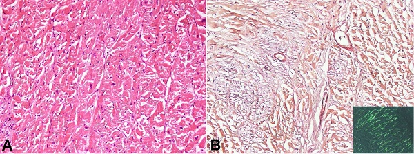 Photomicrographs of the heart showing in A - The presence of a pale eosinophilic material in the interstitium and wall of blood vessels (H&E, 100X); B - Congo red stain demonstrating congophilia in areas with pale eosinophilic material. Inset shows apple-green birefringence on polarizing microscopy (Congo red, 100X).