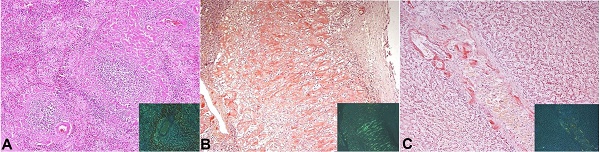 Photomicrographs of the: A - spleen with amyloid deposits (H&E and inset Congo red stain, 200X); B - adrenal gland (Congo red stain, 200X); C - liver (Congo red stain, 200X).