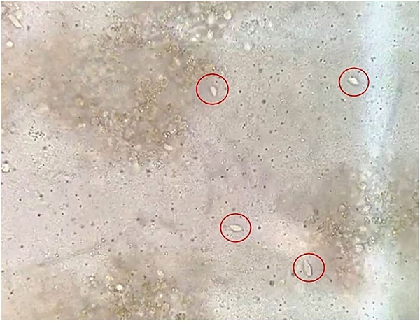 Direct examination of the pleural fluid showing structures similar to Trichomonas (red circles).
