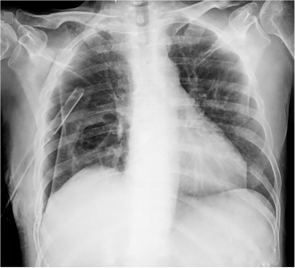 Chest x-ray in postero-anterior view showing the pneumothorax with an area suggestive of a lung abscess in the right lung.