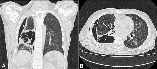 Thoracic computed tomography revealing the right pneumothorax with irregular cavitation with thickened walls located at the pleuropulmonary interface of the posterior margin of the right lower lobe. A &ndash; Sagittal plane; B &ndash; axial plane.