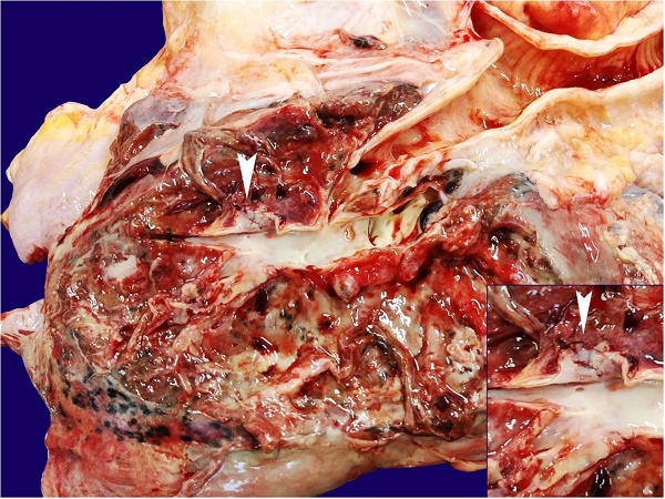 Macroscopic examination of the right lung (posterior face) showing rupture of the lower lobar artery (white arrowhead) and the abscess surrounding the artery. The inset shows the PAA in detail.