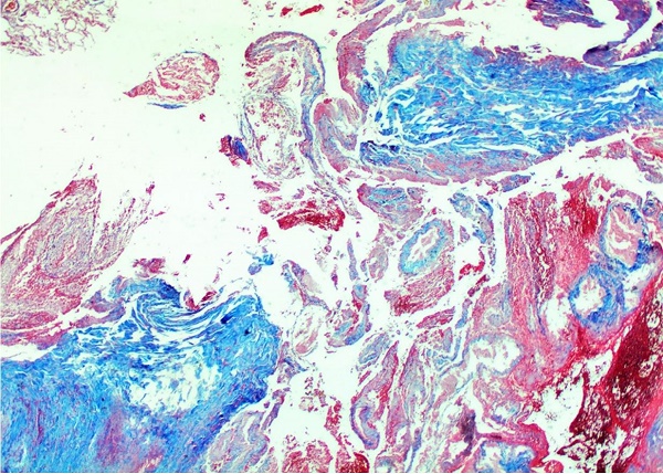 Photomicrograph of the lung showing arterial wall rupture. (Masson's trichrome stain; 20X).