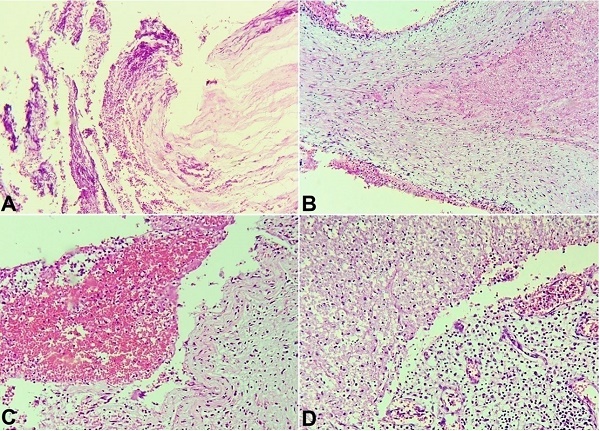 Photomicrographs of: A &ndash; Aneurysm wall showing purulent inflammatory infiltrate and coagulative necrosis (H&E, 200X); B &ndash; Pulmonary artery aneurysm wall with coagulative necrosis, intimal fibroplasia, and mixed inflammatory infiltrate (H&E, 100X); C &ndash; Pulmonary artery aneurysm wall with coagulative necrosis, intimal fibroplasia, and mixed inflammatory infiltrate (H&E, 100X); D &ndash; Granulation tissue and fibrinopurulent pseudomembrane on the inner surface of the pulmonary abscess contiguous to the pleural empyema (H&E, 200X).