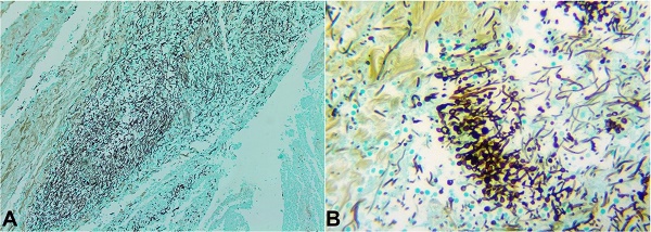 A &ndash; Infiltration of filamentous fungi and spores (Grocott's methenamine silver stain, 40X); B &ndash; Numerous septet and branched hyphae and spores infiltrating connective tissue on the inner surface of the pleural cavity and pulmonary parenchyma exposed through pleurostomy (Grocott's methenamine silver stain, 400X).