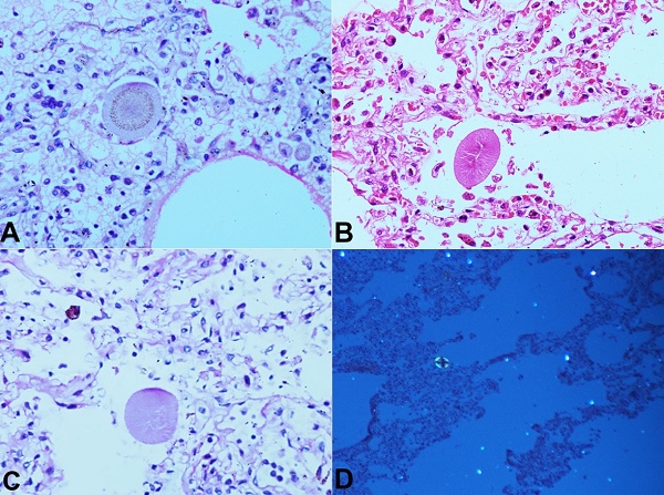 Photomicrographs of the lung showing in A - Pulmonary alveolar microlithiasis ‘Type A’; B - Pulmonary alveolar microlithiasis ‘Type B’ (A, B - H&E 400X); C - Pulmonary alveolar microlithiasis ‘Type C’ (H&E, 200X); D - Congo red stain (400X).