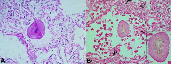 Photomicrographs of the lung showing in A – PAS stain, and B – von Kossa stain of type “B” microlith (400X). In B the inset shows in detail the microlith with granular pigment at the end of the fibrils.