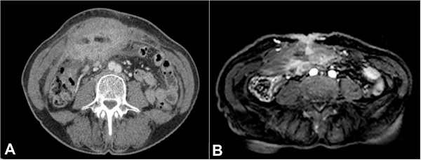 A &ndash; Abdominal enhanced CT scan, axial plane, showing soft tissue mass infiltrating the colon, mesenteric fat and abdominal wall (muscular plane); B &ndash; MRI, T1 weighed with fat suppression after gadolinium injection, showing tissue enhancement similar to the CT image; however, with the skin involvement.