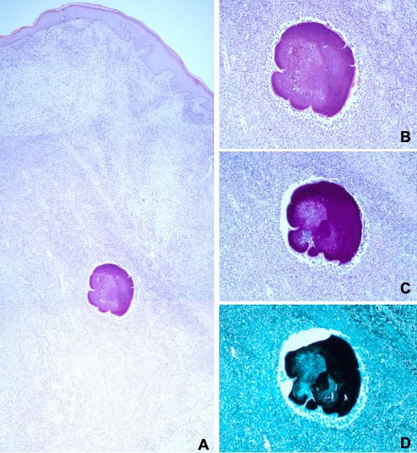 Photomicrographs of the skin biopsy. A &ndash; abundant granulation tissue with associated mixed inflammatory infiltrate extending until the deep dermis, with areas of abscess formation. In the middle of the lesion, there are microorganisms with morphological features characteristic of Actinomyces spp. There was no evidence of the presence of neoplastic tissue (H&E, 40X); B &ndash; Representative Actinomyces spp. microorganism found in the dermis, with associated polymorphic inflammatory infiltrate (H&E,100X); C &ndash; Representative Actinomyces spp. microorganism highlighted using the Periodic acid&ndash;Schiff&ndash;diastase stain (100X); D &ndash; Representative Actinomyces spp. microorganism highlighted using the Grocott&rsquo;s stain (100X).