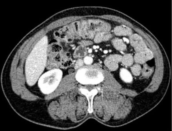 Abdominal CT undertaken after 10 months of antibiotic therapy, showing resolution of the inflammatory process.
