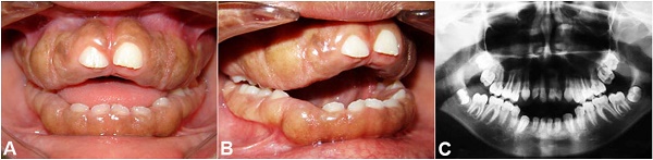 A and B - Intraoral clinical aspects of hereditary gingival fibromatosis. Note the severe and generalized gingival enlargement involving both the maxillary and mandibular arches. In some regions, the entire crown is covered by fibrous tissue, and in others, it covers almost two-thirds of the clinical crowns; C - Panoramic radiograph showing all permanent teeth present and normal development of the dentition.