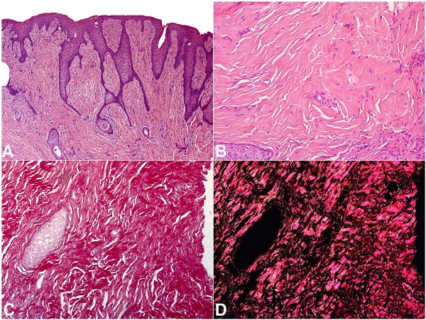 Photomicrographs of the gingiva. A and B - Gingival connective tissue poorly vascularized and exhibiting marked deposition of collagen fibers underlying an epithelium with acanthosis and elongated rete ridges (H&E, original magnification 100X and 200X for A and B, respectively); C and D - Picro-sirius red staining reveals that the enlarged gingival tissue is primarily the result of an increased amount of collagen fiber bundles (picro-sirius stain, original magnification 200X for C and D).