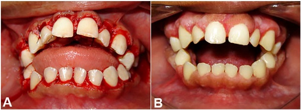 Intraoral examination. A - Immediate postoperative aspect; B - Clinical aspect six months after surgical removal of the excess gingival tissue, with no signs of relapse.