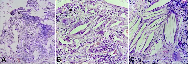 Photomicrographs of sections from the lung. A – Cholesterol clefts along with chronic interstitial inflammation (H&E, 100X); B – Cholesterol clefts along with numerous foamy lipid laden macrophages and dense lymphoplasmacytic infiltrate (H&E, 400X); C – a multinucleated giant cell with cholesterol clefts; an early manifestation in the development of cholesterol granulomas (H&E,400X).