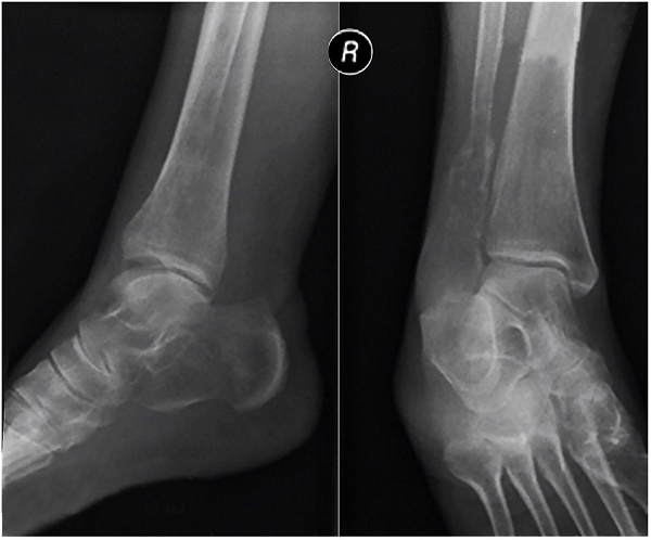 Plain X-Ray of the right foot. Fibula’s infiltrative bone destruction.