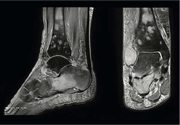 MRI of the right foot. T2-weighed images showing abnormal signals involving tibia, fibula, talus and metatarsal bones.