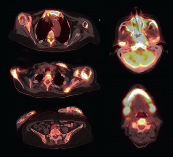 18F-FDG PET/CT imaging demonstrating high FDG uptake in the majority of scanned bones. Cranial and long bones of arms and legs are more severely affected, with soft tissue masses accompanying the bone lesions.