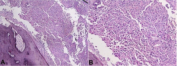 Photomicrographs of the bone biopsy. A – Diffuse infiltration of bone by a large cell lymphoma (H&E, X100); B – Higher magnification of the cell infiltrate (H&E, X200).