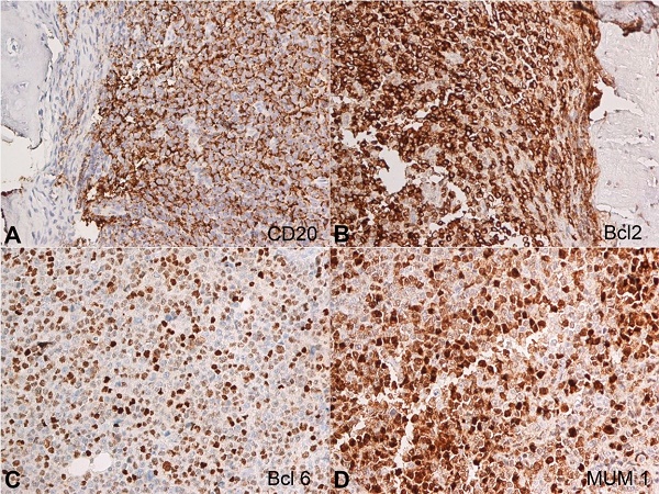 Photomicrographs of the bone biopsy. A – CD20 (X200) expressed by lymphoma cells; B – BCL2(X200) positive expression; C – BCL-6 (X200) positive; D – MUM1 (X200) positive.