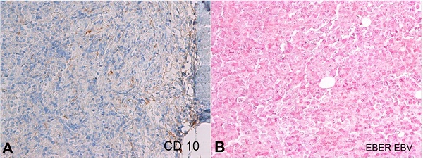 Photomicrographs of the bone biopsy. A – CD10(X200) negative; B – In situ hybridization (EBER) for EBV (X200), negative.