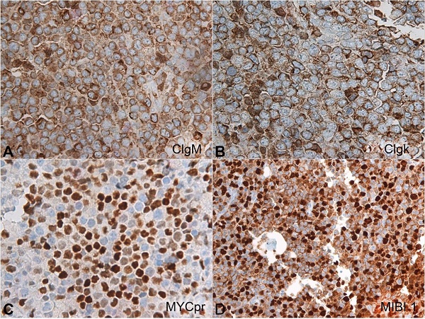 Photomicrographs of the bone biopsy. A – CIgM(X400) positive; B – CIgκ (X400) positive; C – MYC (X400) > 40%; D – High rate of proliferation MIB1 (X200) overall ~90%.
