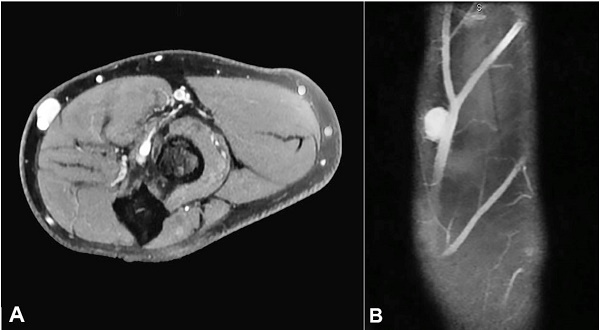 A – MRI of the left leg T1 Weighted image, after gadolinium injection, showing a saccular lesion in the popliteal artery topography; B – MR angiography reconstruction of popliteal artery showing the lesion.