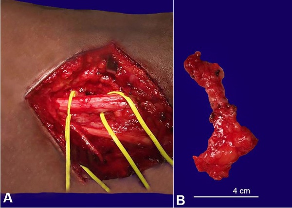 A – Intraoperative view of the sciatic nerve, in the popliteal fossa after resection of the tumor; B – Gross view of the resected tumor (lipoma).