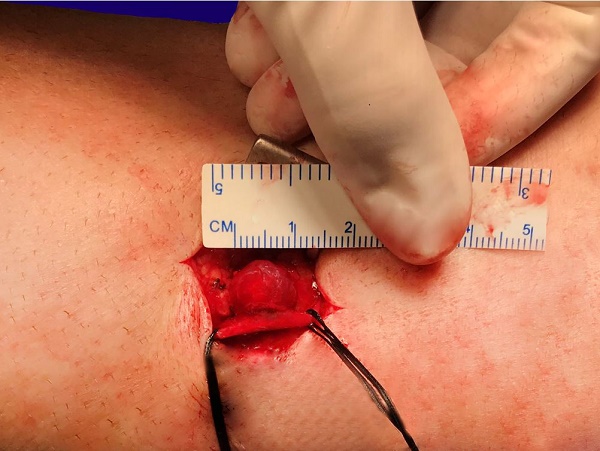 Intraoperative view of the vascular lesion compressing the medial cutaneous branch that is isolated by the surgical treads.