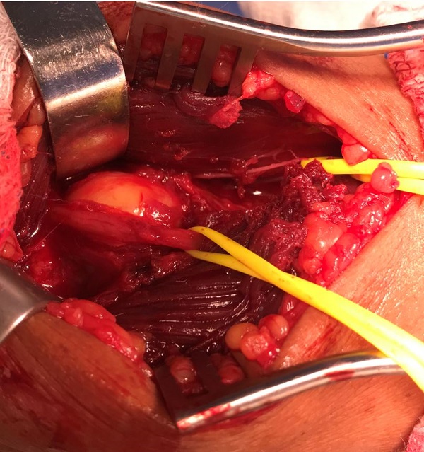 intraoperative view the vascular lesion with close contact and compressing the medial cutaneous branch isolated by the yellow surgical tape.