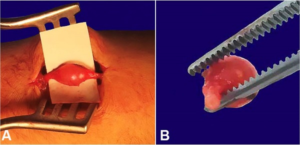 A – intraoperative view of the vascular lesion in the forearm; B – capillary haemangioma.