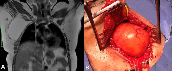 A – Thoracic MRI showing a right axillary expansive lesion displacing the right brachial nervous plexus; B – Intraoperative view - right supraclavicular lipoma.