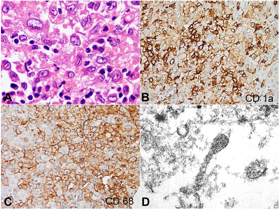 Photomicrographs of the lymph node showing in A &ndash; Characteristic Langerhans cells with convoluted nuclei and nuclear grooves (H&E x1000); B, C &ndash; Langerhans cells immunoreactive for CD1a and CD68 (B and C x400); D &ndash; Racket-shaped Birbeck granules within the cytoplasm of LC (uranyl acetate with lead citrate, x36,000).